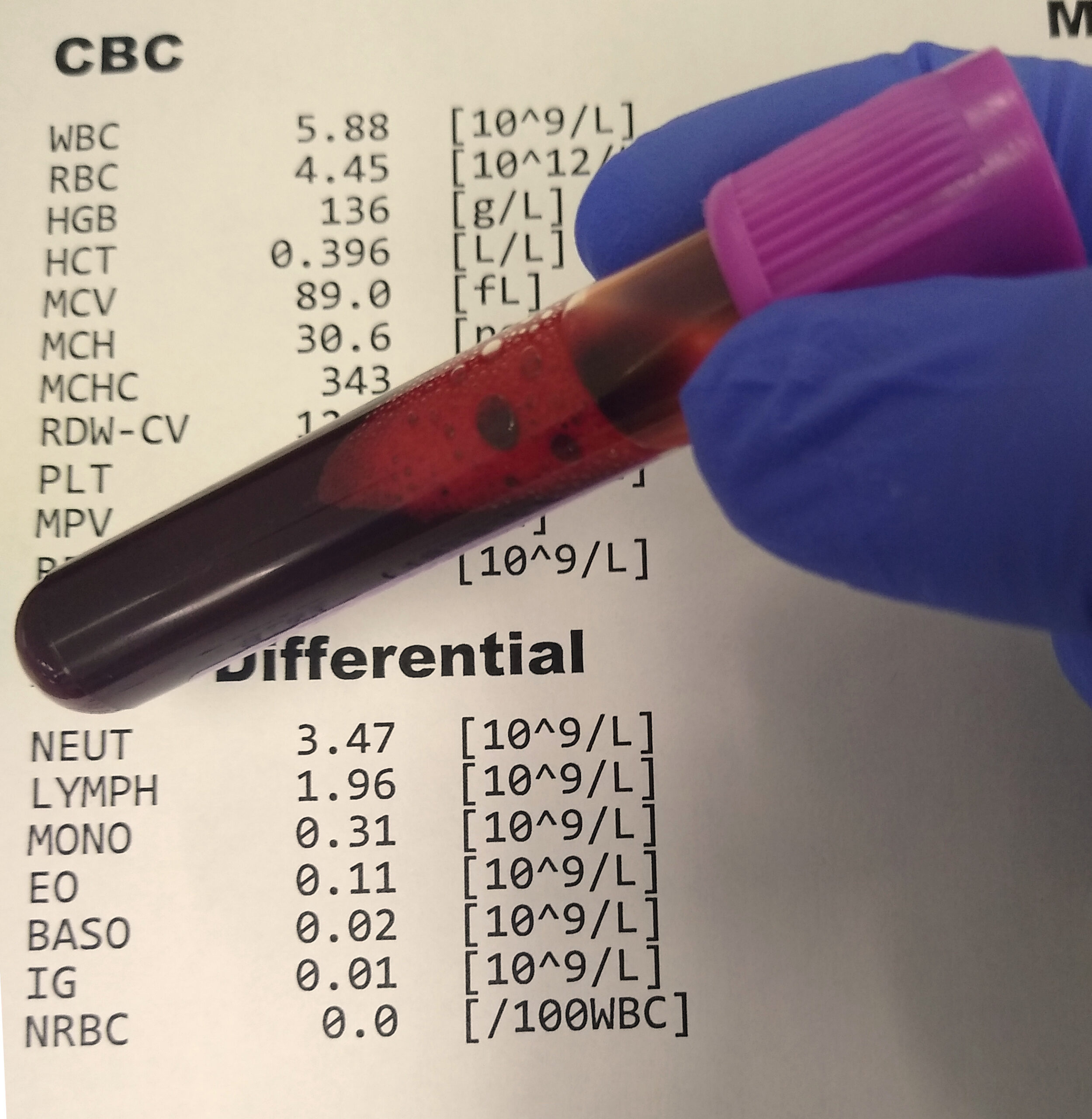 Resultado de hemograma completo com diferencial de leucócitos
